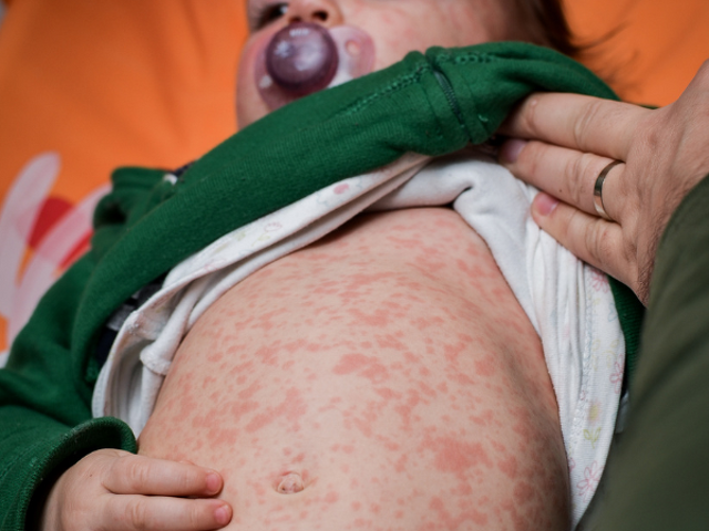 Measles Outbreak